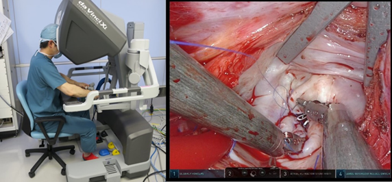 右小開胸のMICS(ミックス)手術とロボット (ダビンチ) 支援手術