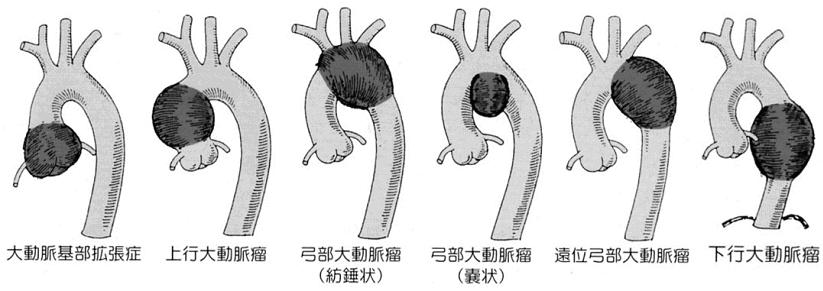 大動脈瘤