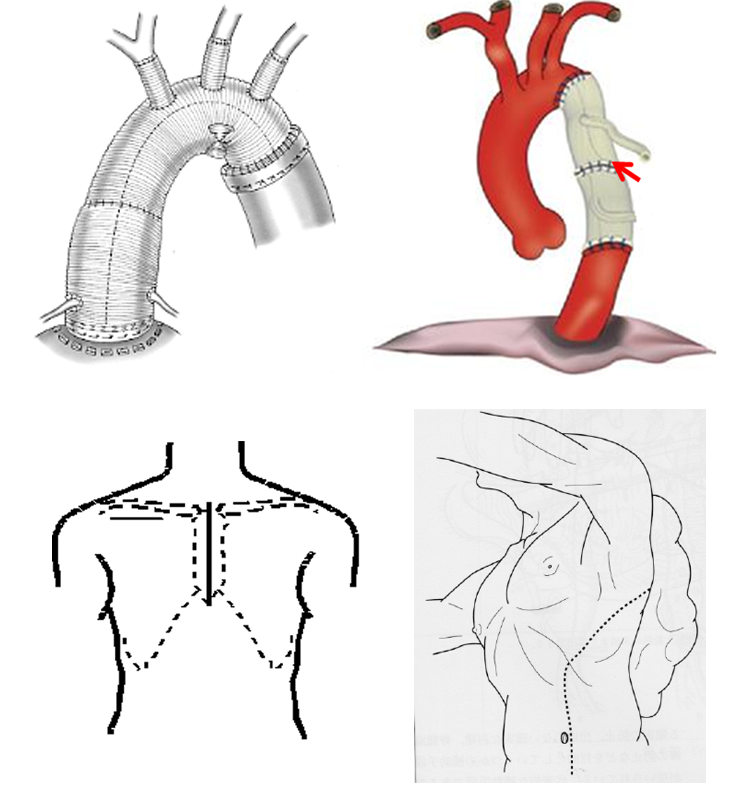 胸部大動脈手術