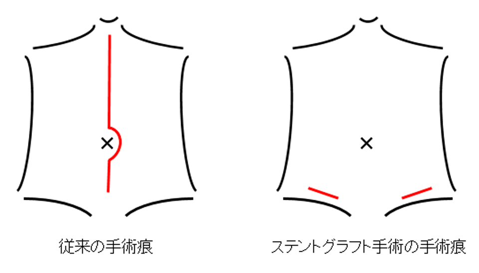 手術の内容