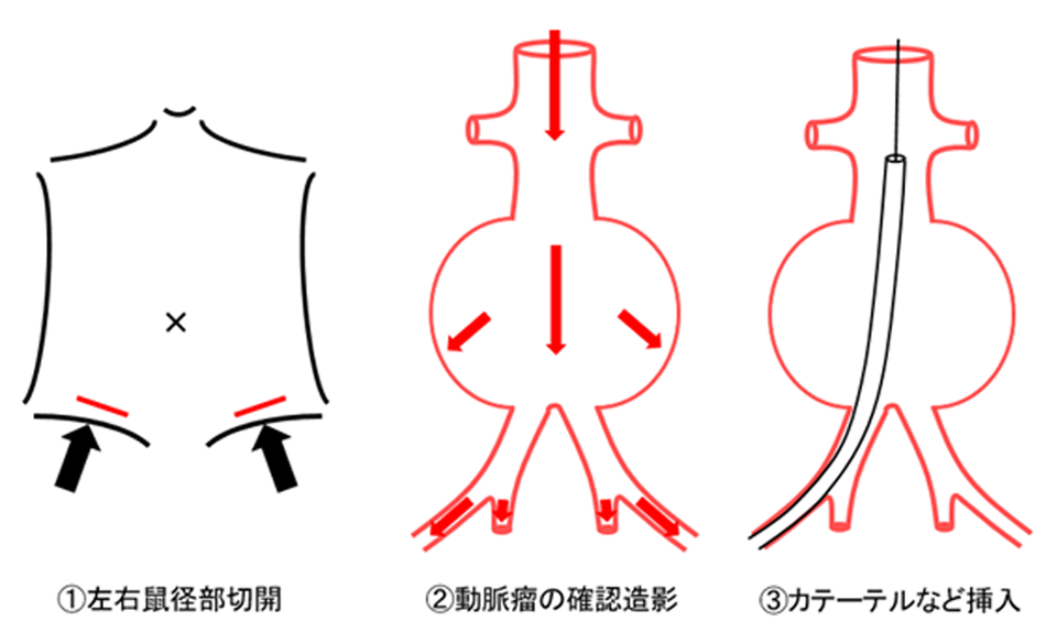 手術の内容