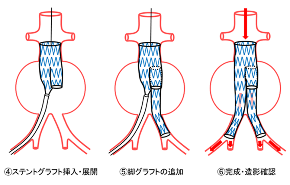 手術の内容