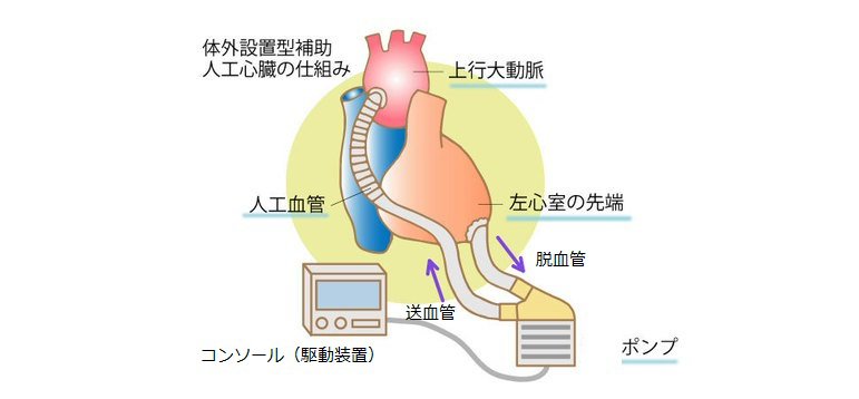 3.補助人工心臓（VAD）