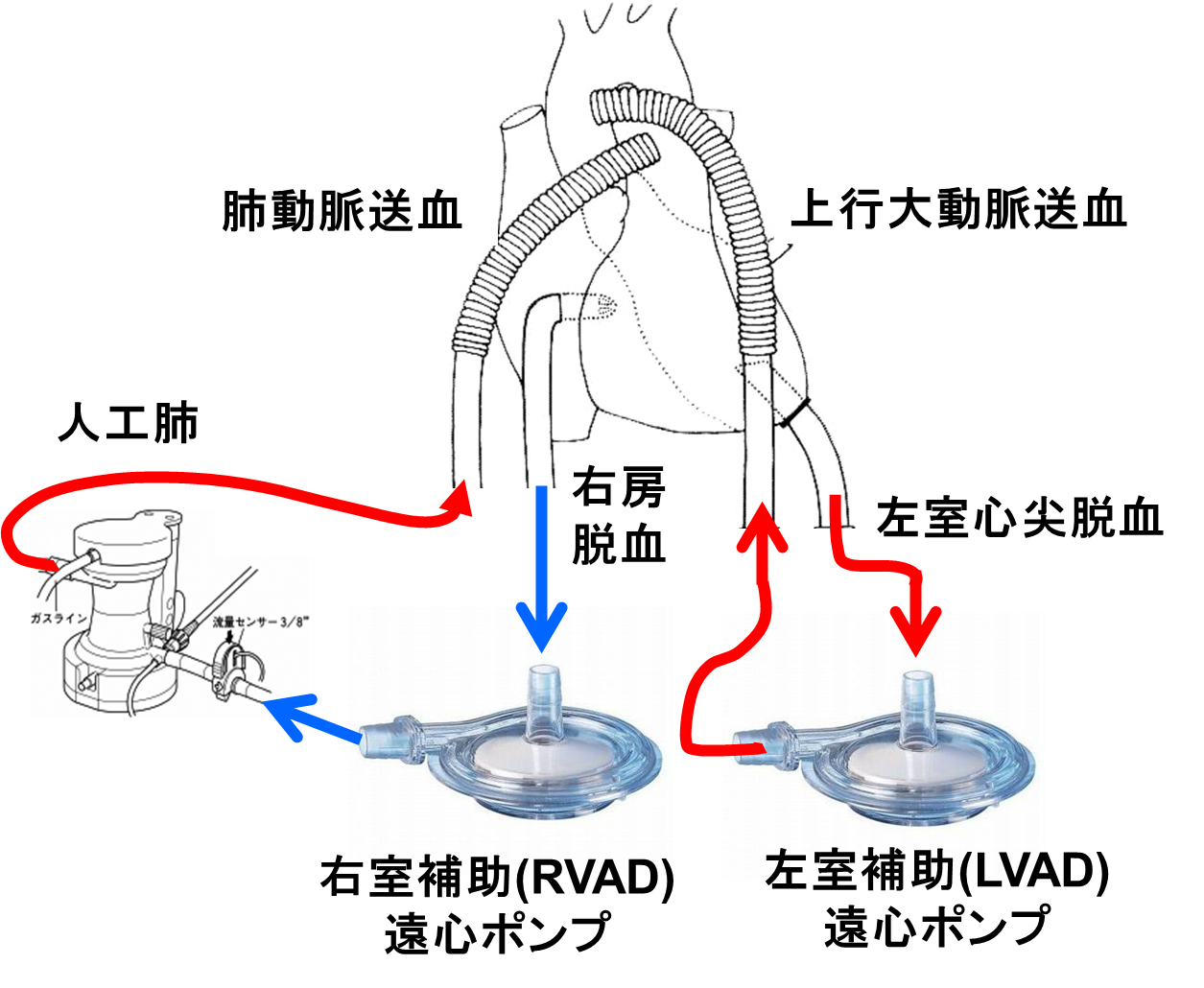 遠心ポンプによる体外式補助人工心臓