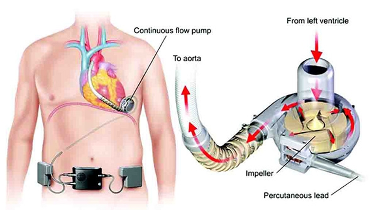 植込型補助人工心臓（I-VAD）