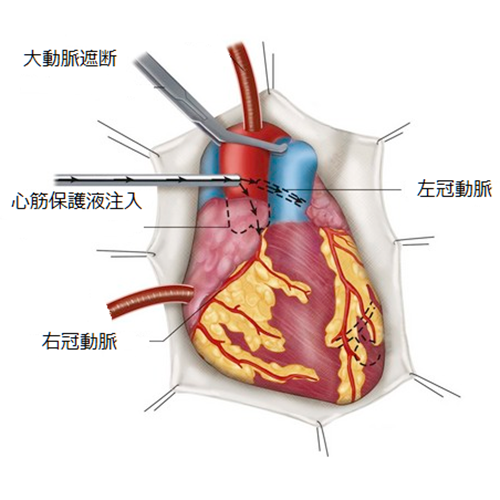 心停止