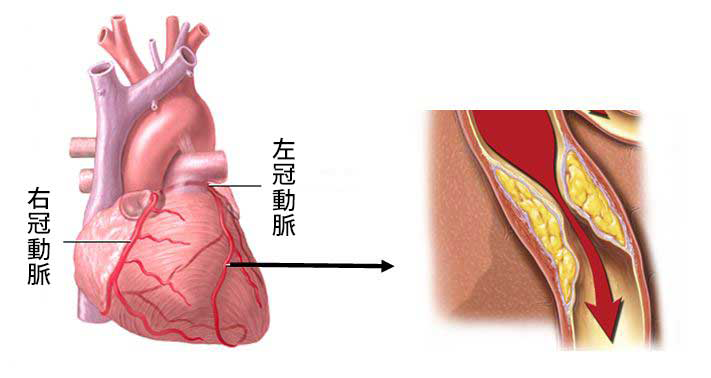 冠動脈バイパス手術