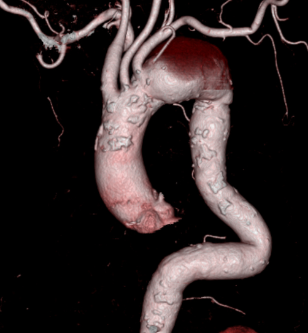 【80歳　男性】突出する弓部大動脈紡錘状瘤