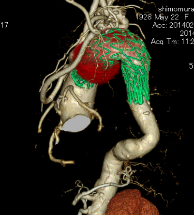 頸部動脈デブランチ+胸部ステントグラフト留置