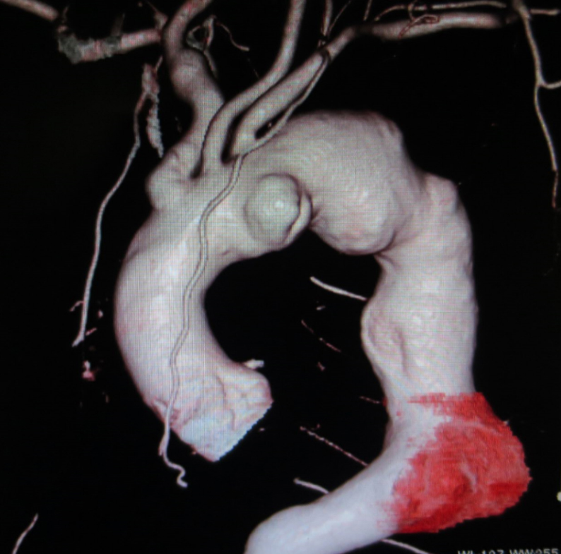 【61歳　男性】広範な弓部下行く大動脈瘤