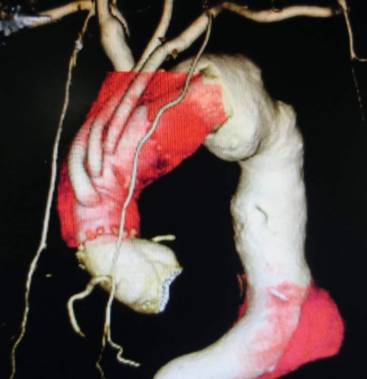 第1期手術:上行弓部大動脈人工血管置換